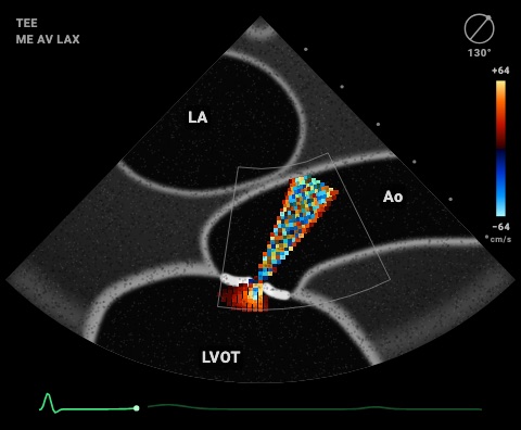 Stenosi aortica severa in medio-esofagea asse lungo della valvola aortica