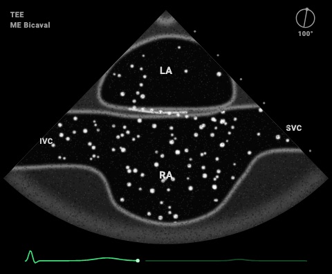 Forame ovale pervio con microbolle in vista bicavale