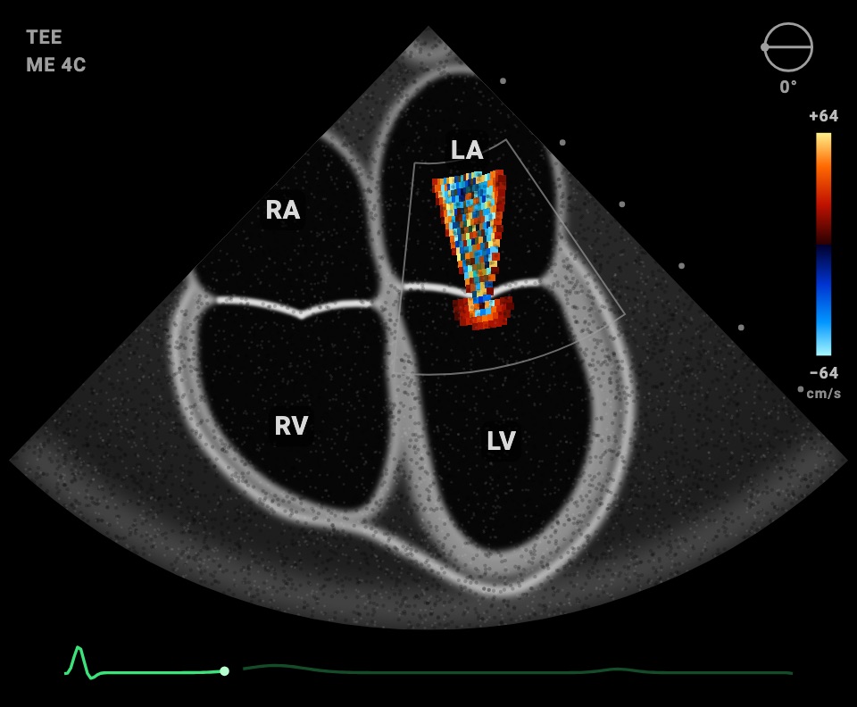 Schema TEE quattro camere medio-esofagea con getto di insufficienza mitralica al color Doppler